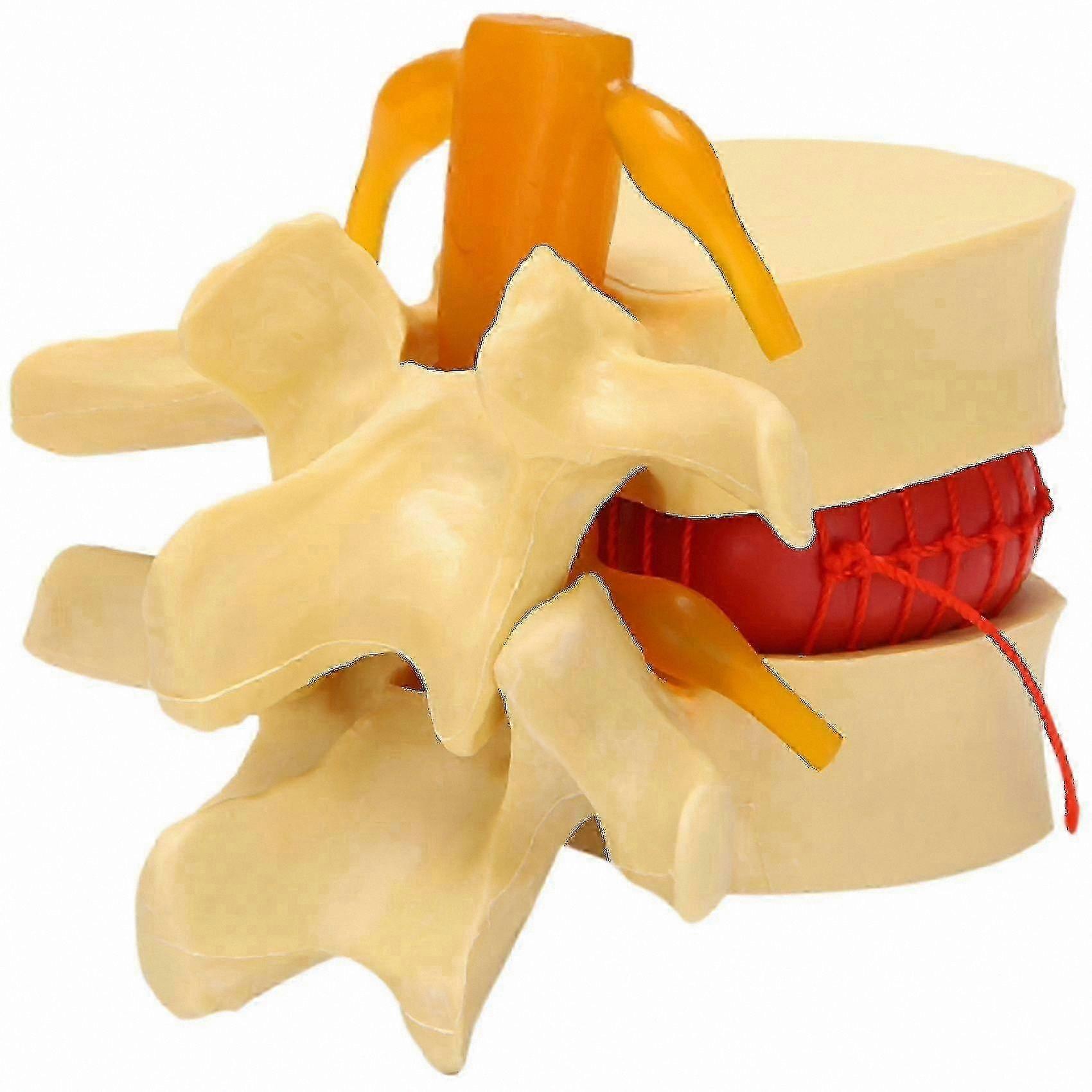 Anatomical Lumbar Spine Model with Disc Herniation for Educational Use
