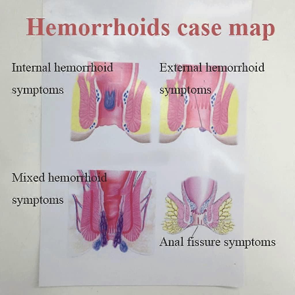 Human Anorectal Pathological Model Anorectal Fistula Fissure Lesion Model In Rectal Hemorrhoids Medical Anorectal Model Models