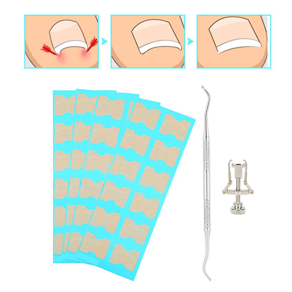 Ingrown Toenail Correction Patch 48pcs 1.8x1.4cm Elastic PVD Tool