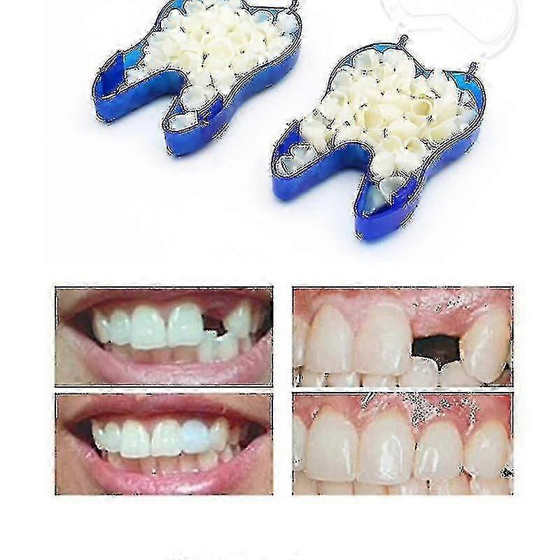 Temporary Upper Denture Veneer for Missing/Broken Teeth, Natural Fit & Look