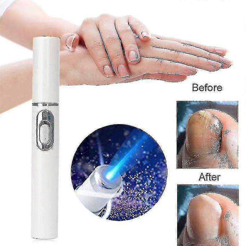 Neglesopp Laser Pointer med blått lys, smertefri manikyr for onykomykose-MXBC
