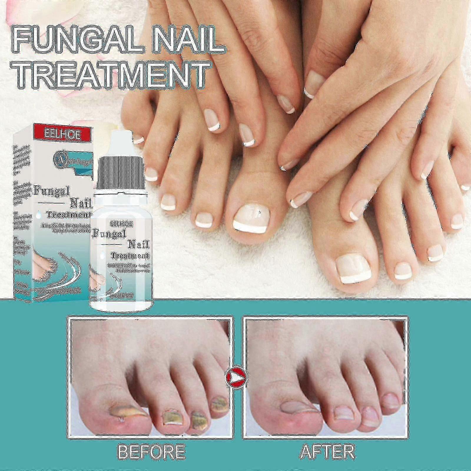 Eelhoe Nail Onycho Liquid Nail Care Solution