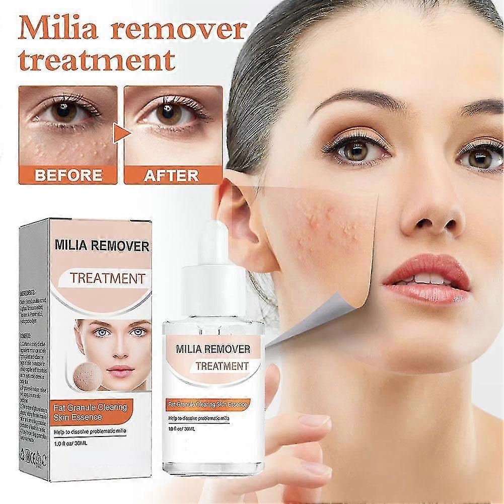 Milia Remover - ממיס ומפחית מיליה, Whitehead, היפרפלזיה של חלב - 30 מ"ל