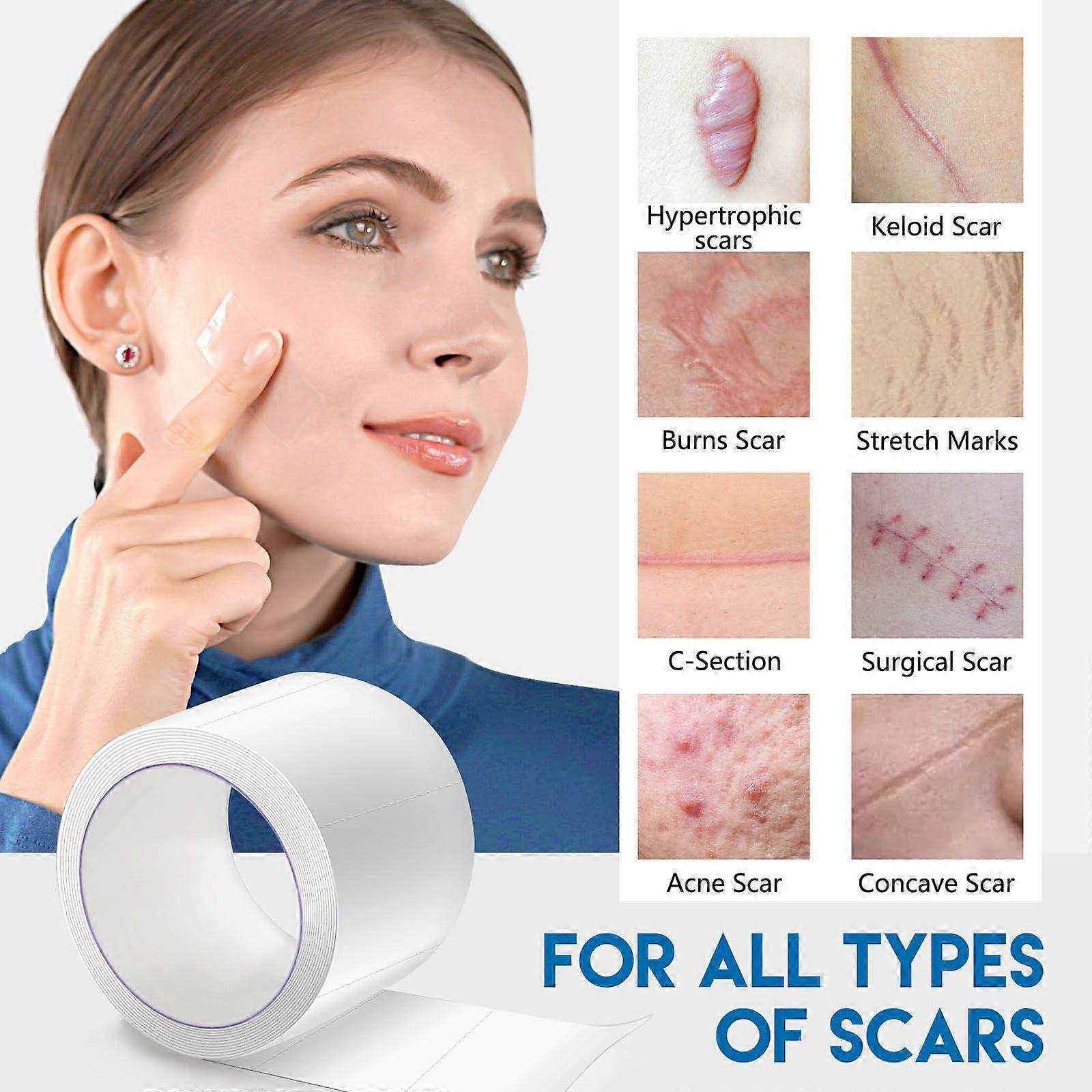 رقعة الندبة ، لفة شريط الندبة ، شريط الندبات ، مزيل الندبات القابل لإعادة الاستخدام للجزء القيصري ، الجدرة ، إلخ. 1.5 م * 2.5 سم