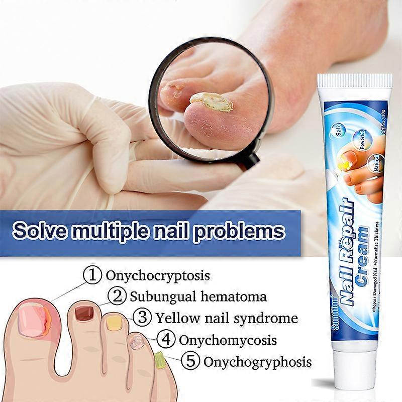 20g Tırnak Onarım Kremi Ayak Tırnağı Mantar Jel Tedavisi Onikomikoz Kaldırmak ve Onarmak İçin Renk Bozulmasından Korur