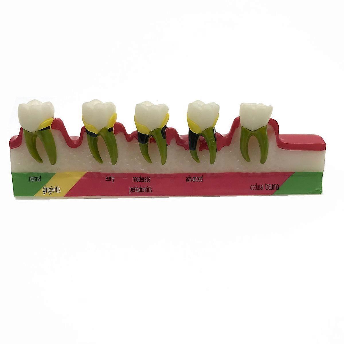 Dental Periodontal Disease Assort Tooth Typodont Model