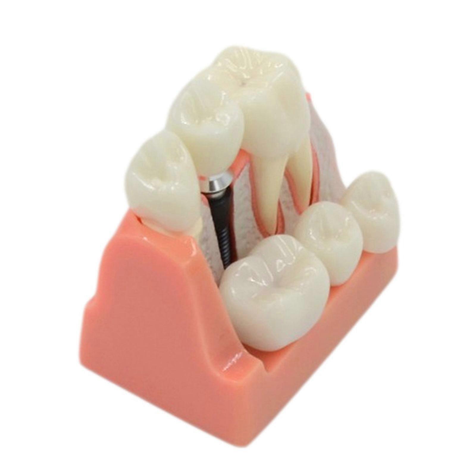 Removable Dental Implant Teeth Model Analysis Crown Bridge Model Teaching Aids