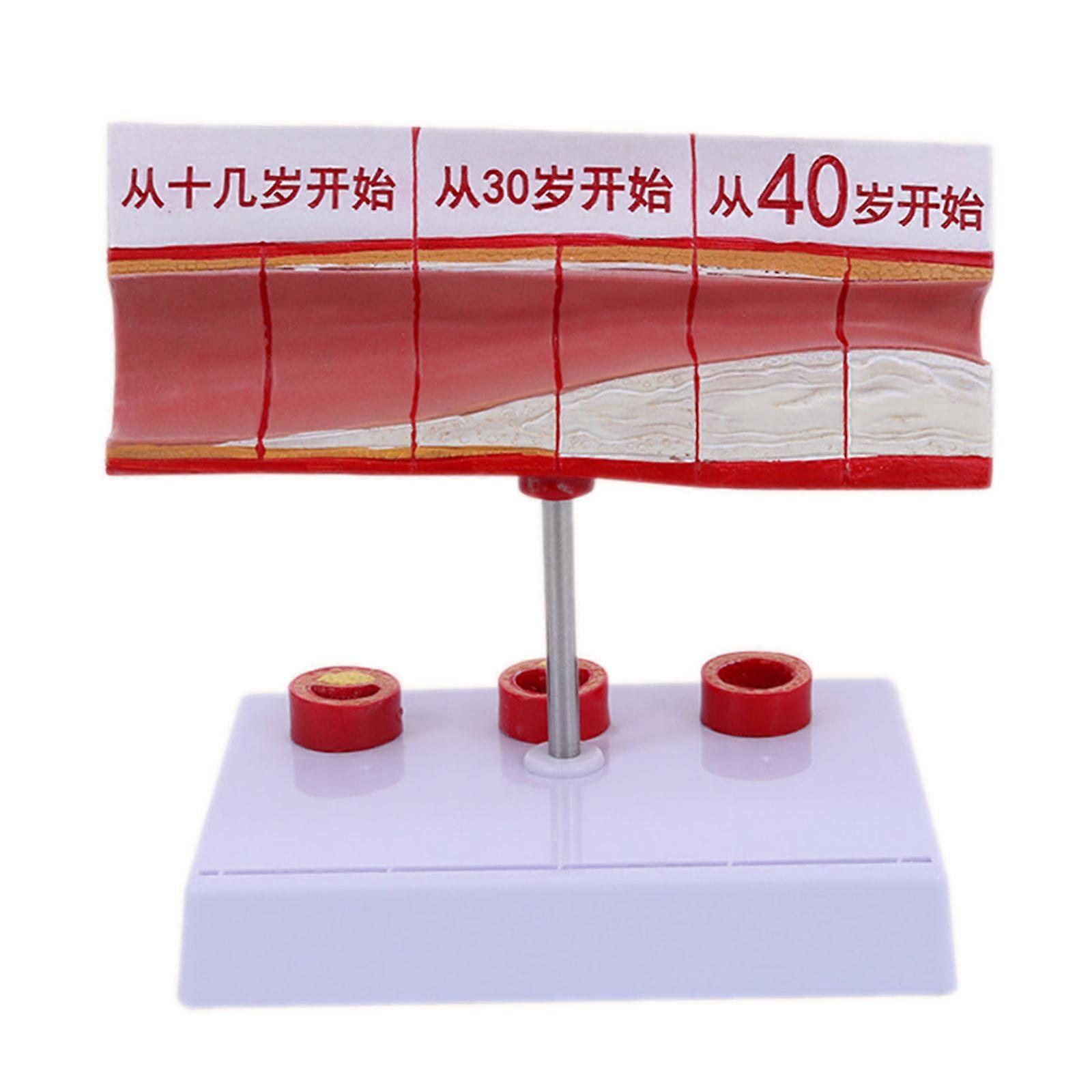Mannequin Human Atherosclerosis Cardiovascular Model Blood Vessel Anatomical Model Arterial Vessel Model for Teaching
