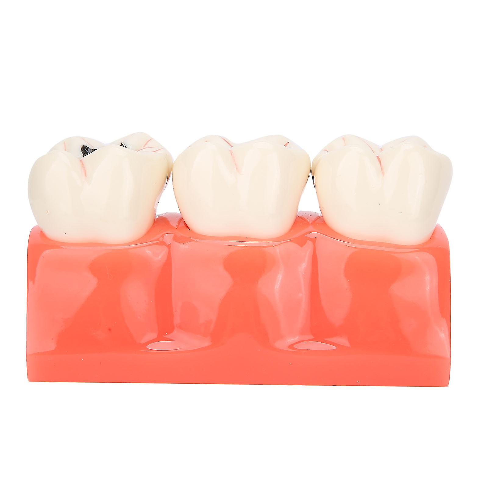 2024 New,dental Caries Model Tooth Decay Demonstration Model Simulation Detachable Teeth Model