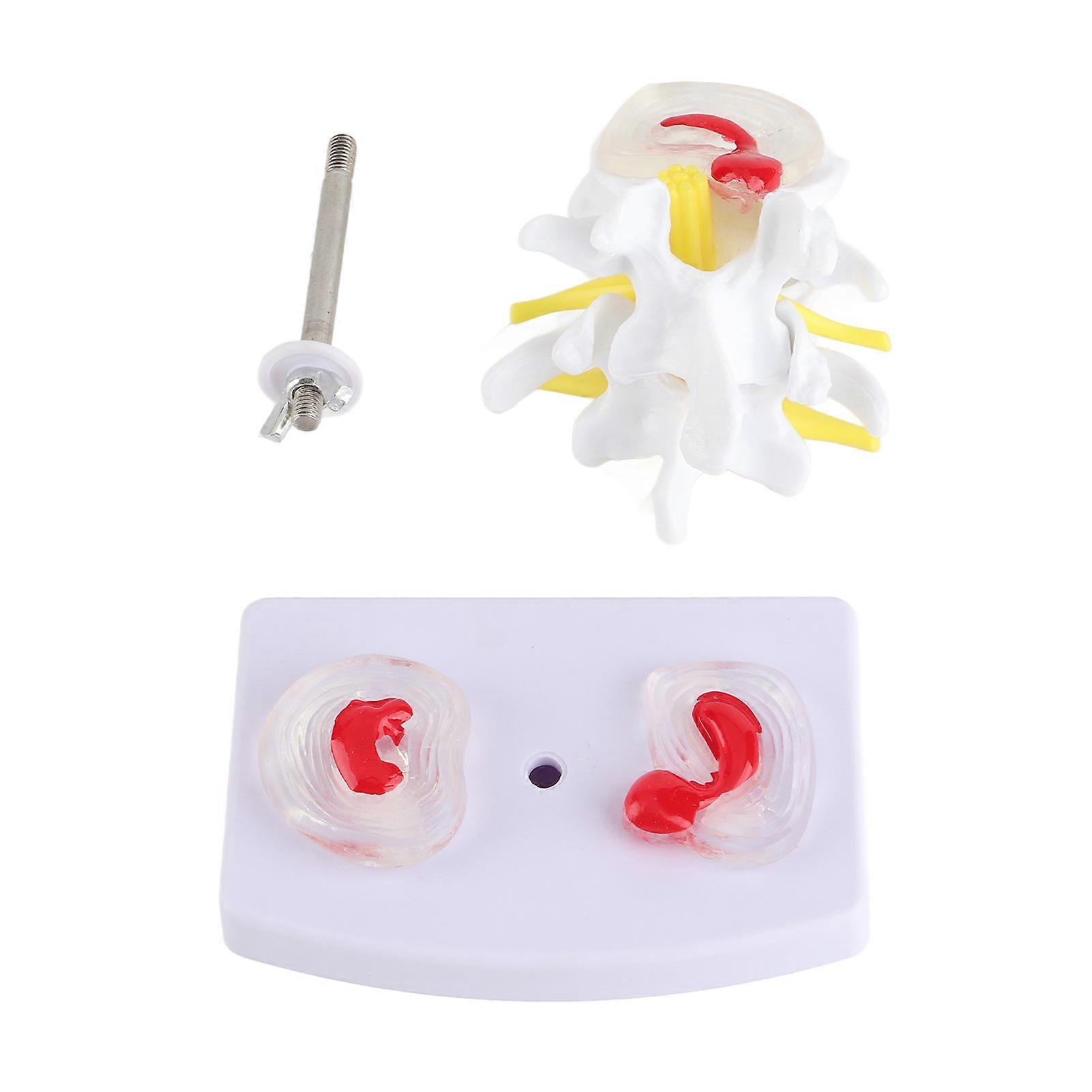 Anatomical Lumbar Disc Herniation Demonstration Model Human Spine School Training Supplies