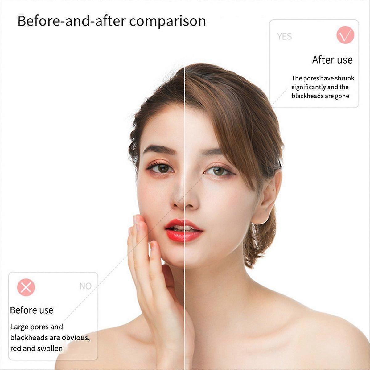 Elektrisk Hudormfjerner Ansiktskvise Ekstraksjon Rens