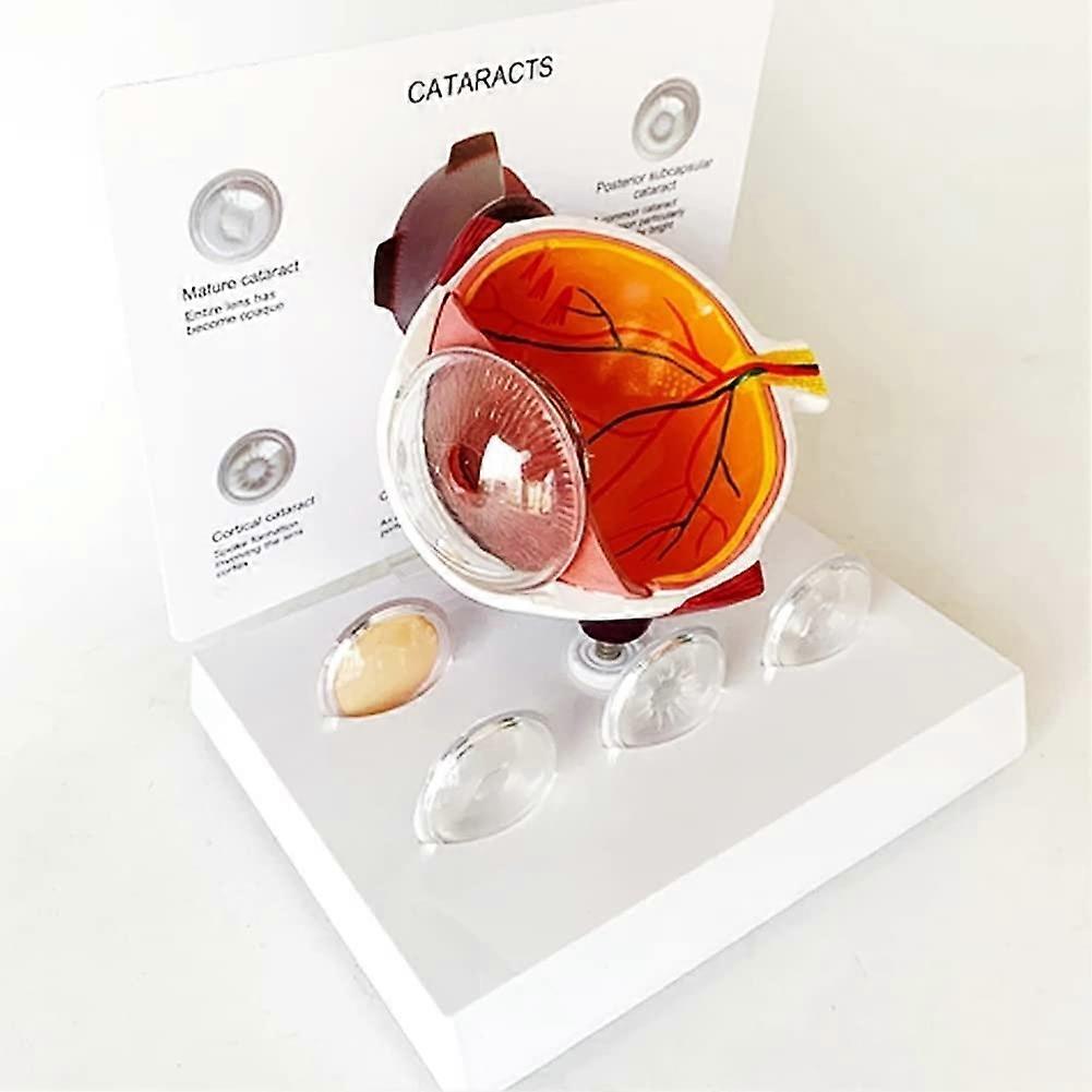 Cataract Eye Model Oversized Eye Model Eyeball (Glaucoma) Model Disease Model Eyeball Pathology Set of 5 Interchangeable Lenses for Education