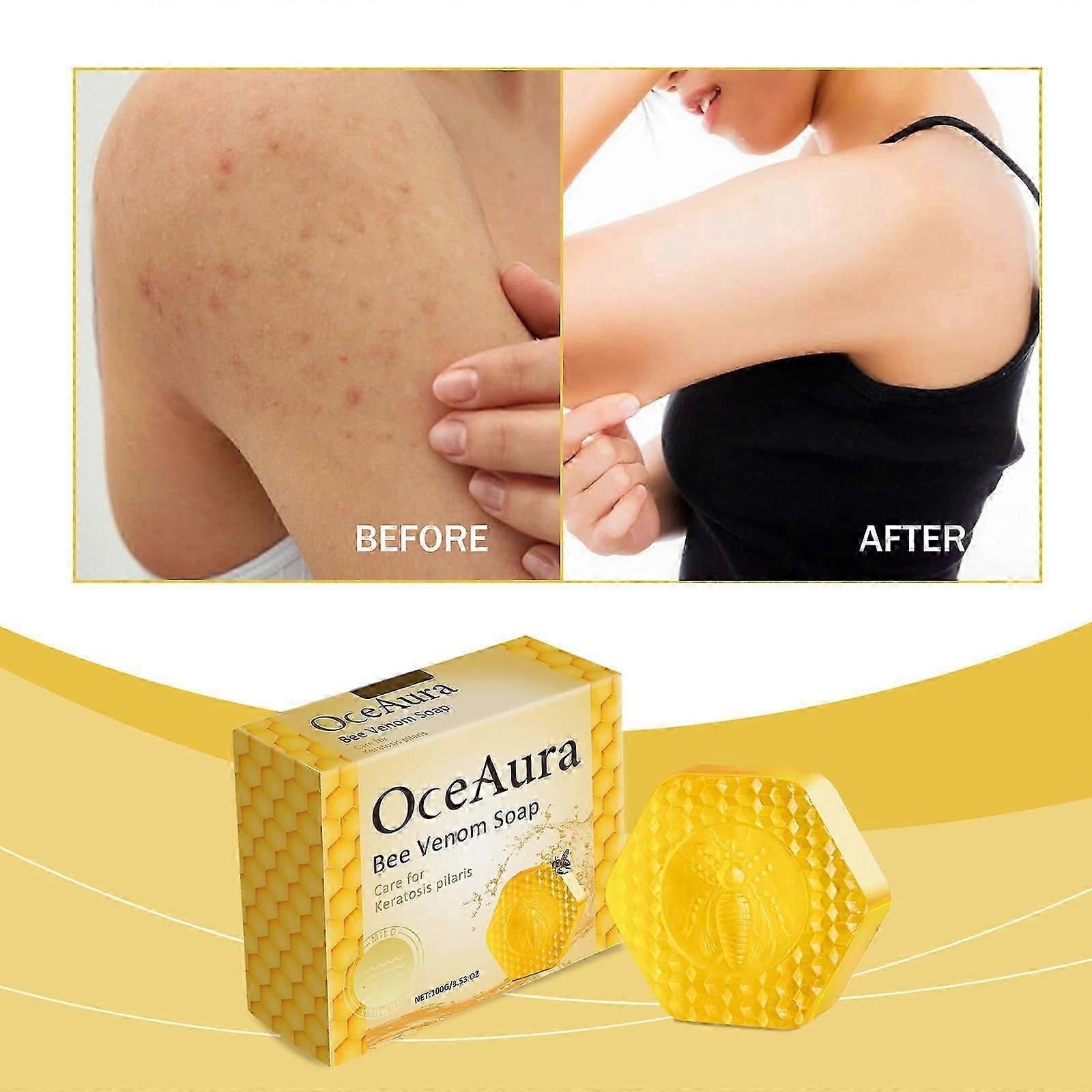 Σαπούνι δηλητηρίου μέλισσας Keratosis Pilaris, Σαπούνι Keratosis Pilaris, Σαπούνι Keratosis Pilaris Bar, Σαπούνι θεραπείας Keratosis Pilaris