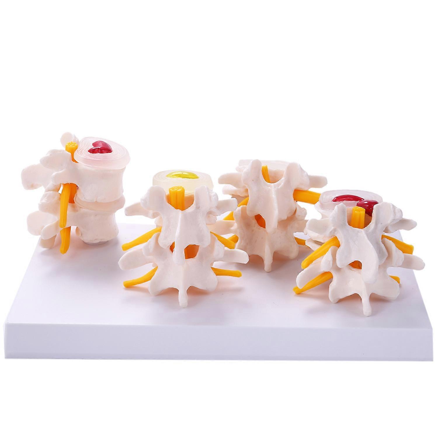 Human Anatomy Skeleton Spine 4-Stages Lumbar Vertebral Skull Traumatic Teaching Supplies