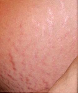 Concentré Argan Roll-On Anti-Vergetures