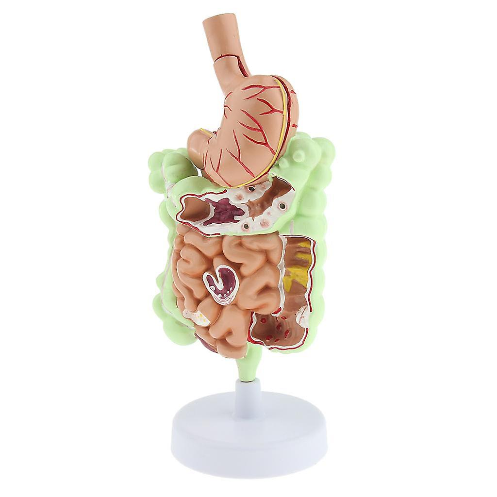 Human Gastrointestinal Pathology Model Anatomy Study