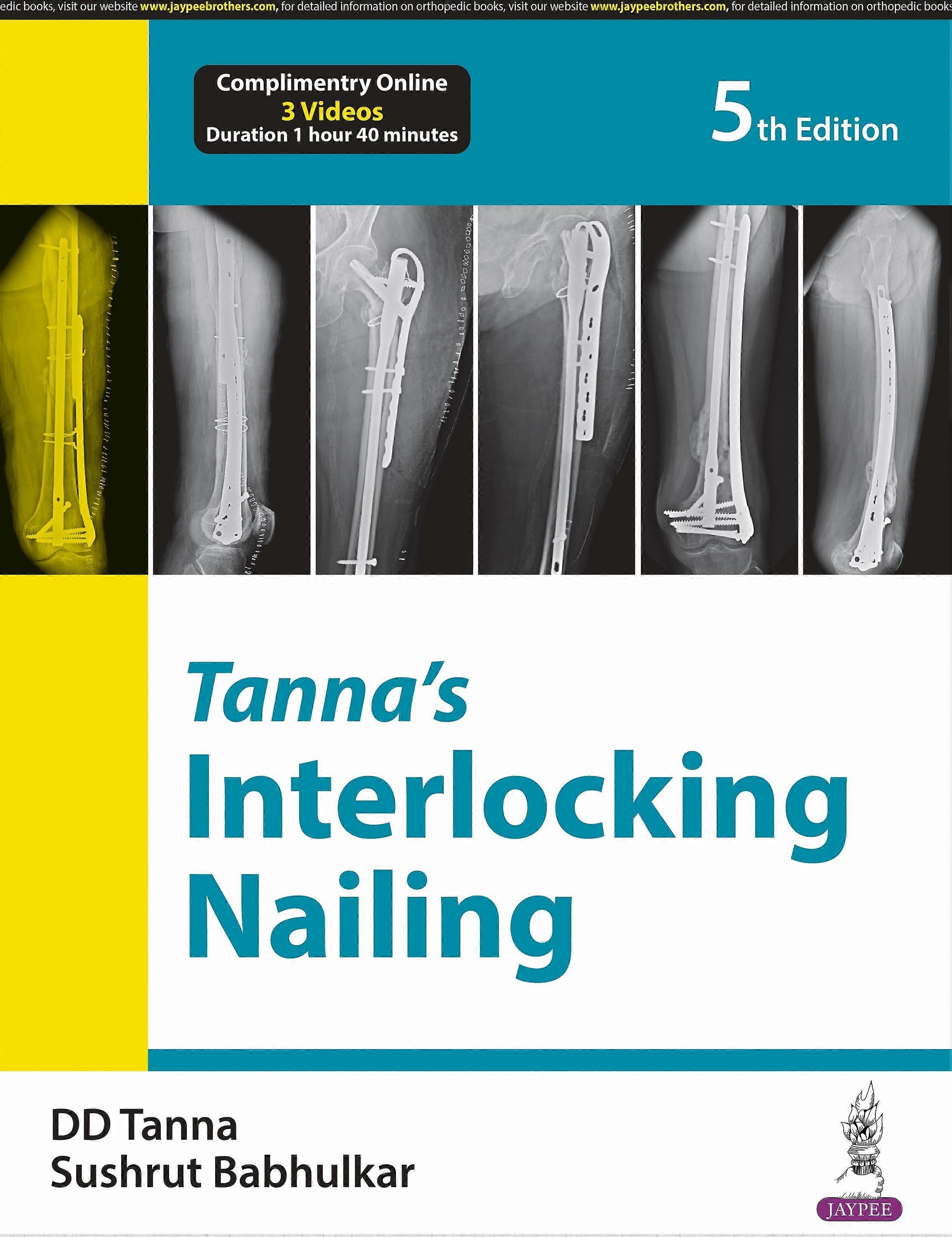 Tannas Interlocking Nailing by DD Tanna Paperback Book