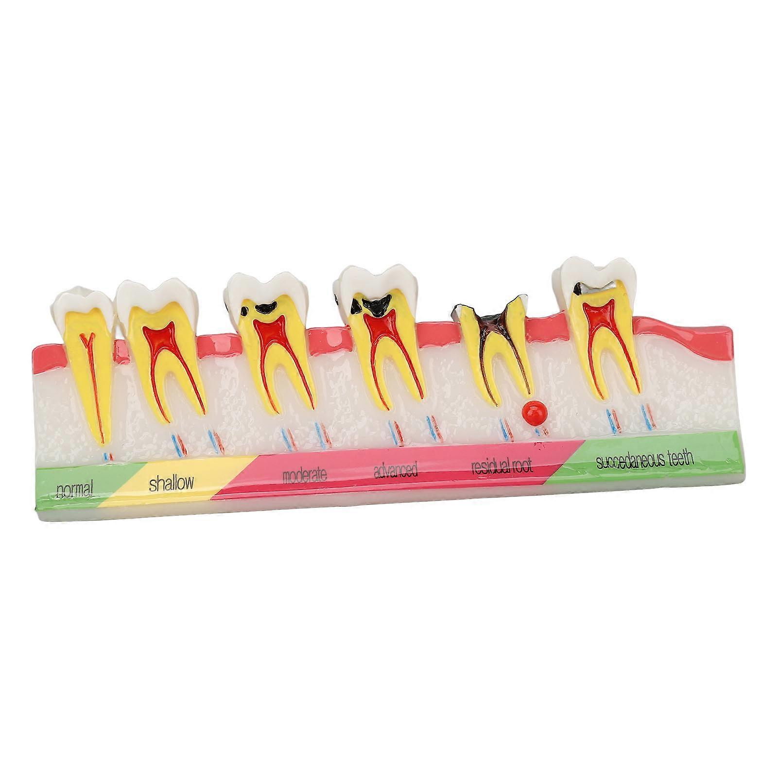 Dental Caries Model 6 Different Stages Resin Decayed Tooth Display Model