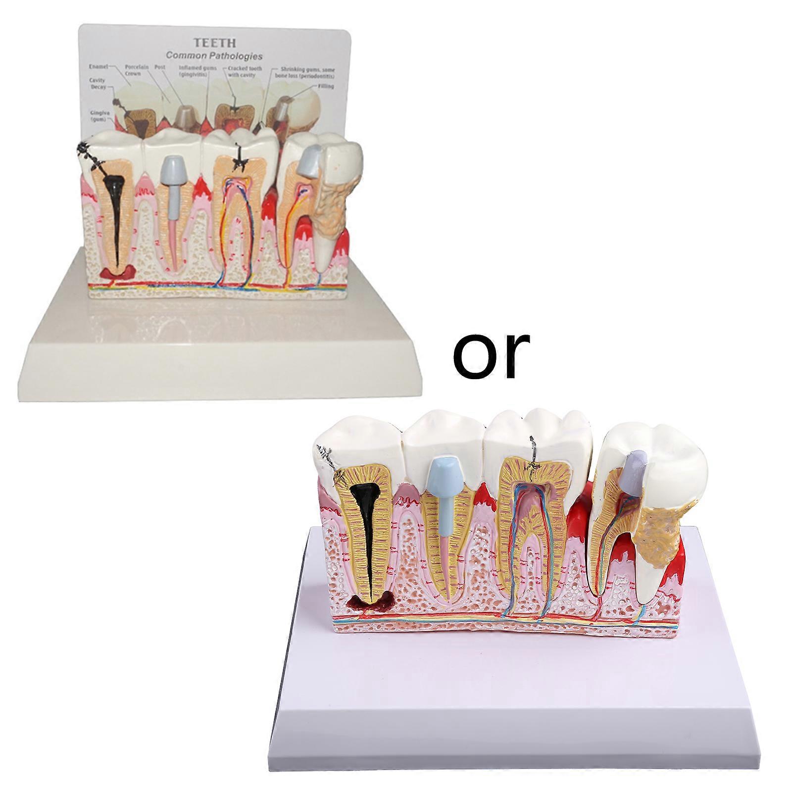 7x5.9x5.1inches Demonstration Teeth Model Disease Assort Tooth Dental Teach Study Standard for Class Education