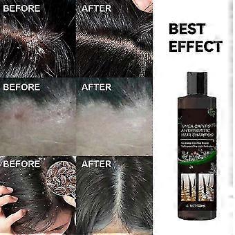 Anti-itch For Tinea Capitis To Dandruff And Relieve Itchy Scalp 26s