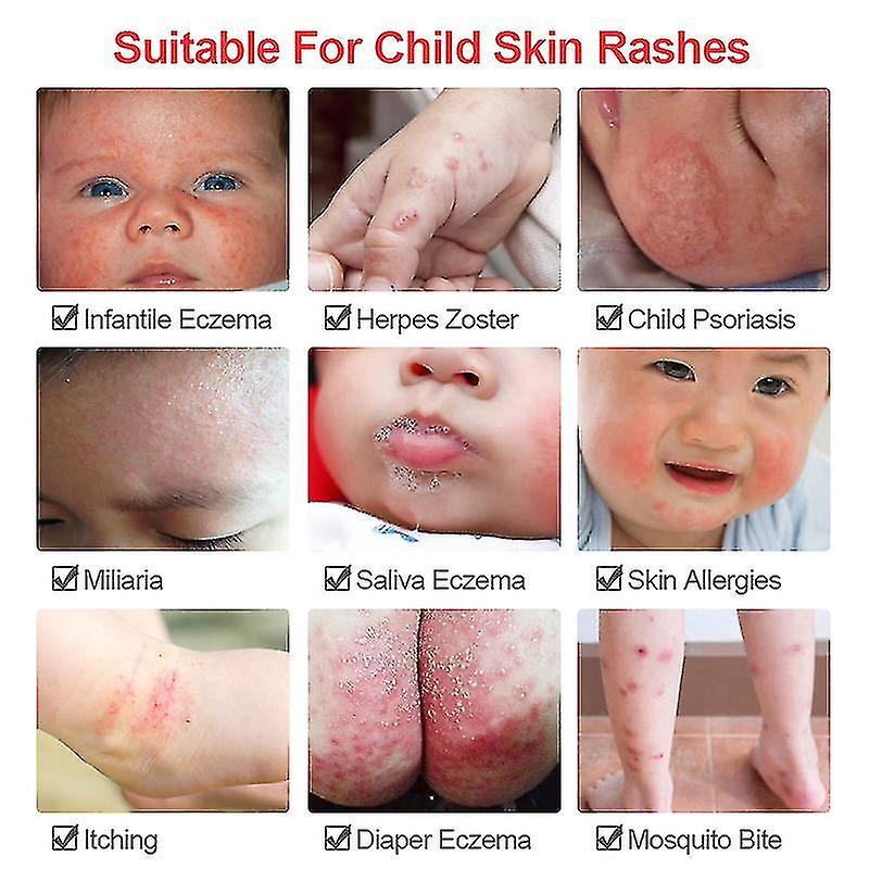 3pcs Baby Hips Dermatitis Eczema Pruritus Ointment Child Face Rash Skin 3pcs baby hips dermatitis eczema pruritus ointment child face rash skin