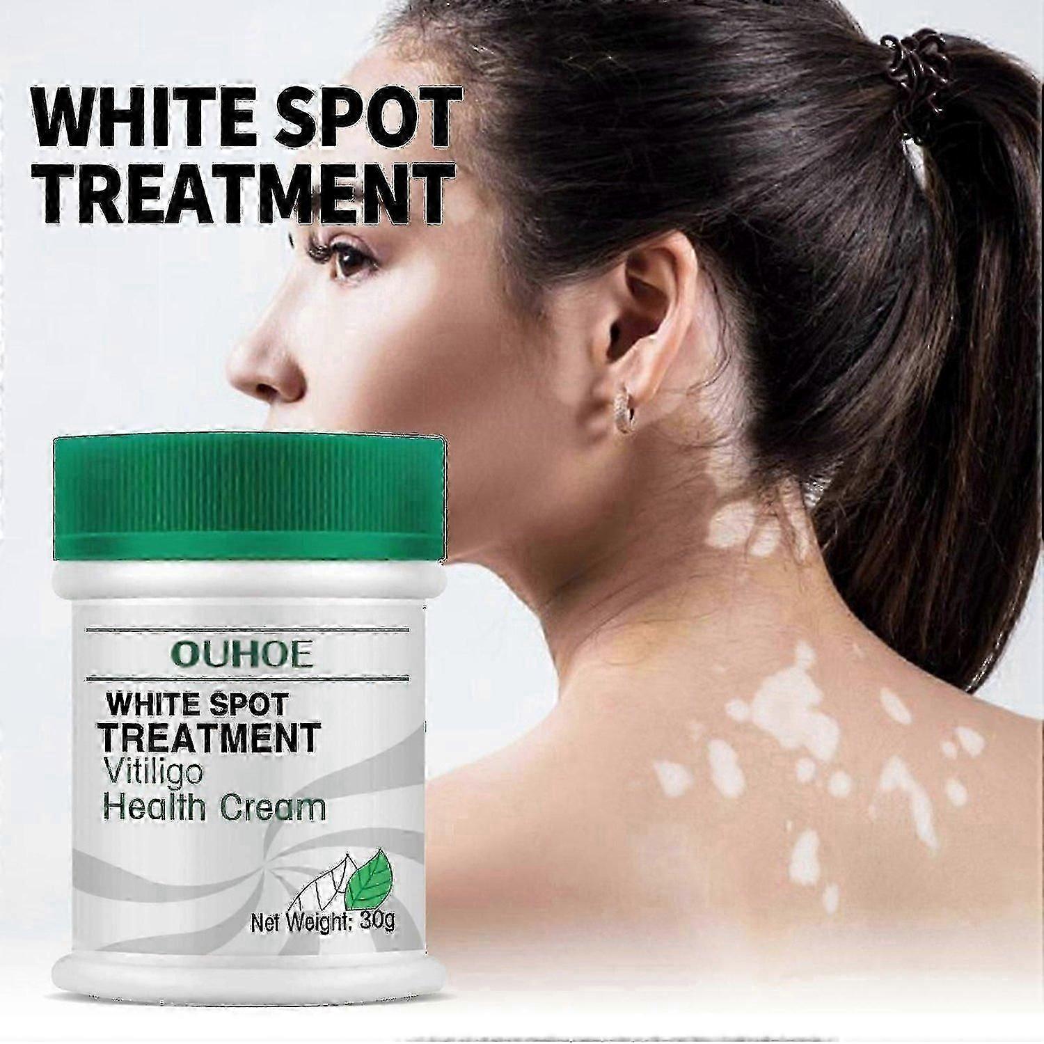 コンフリー白斑治療軟膏が白斑を軽減 30ml