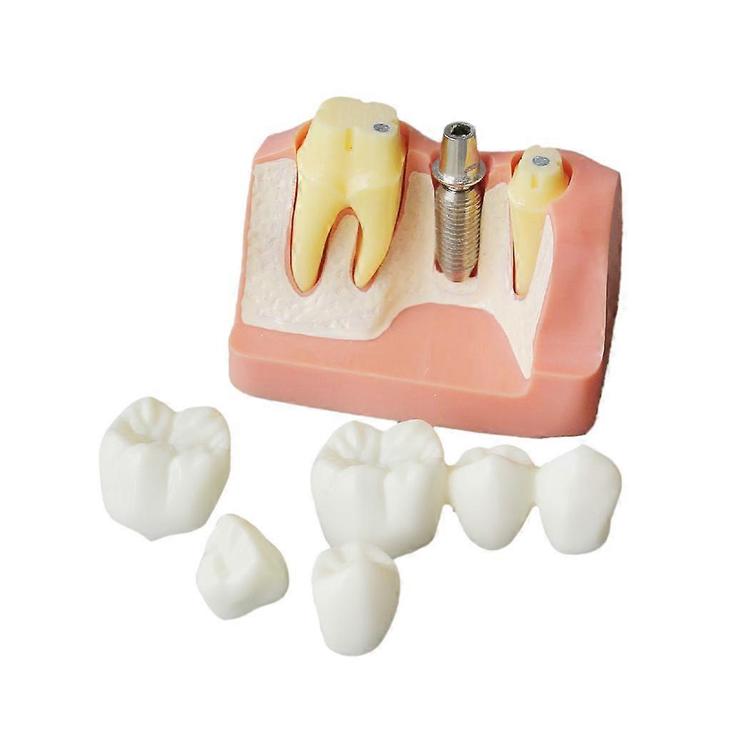 Implant Analysis Bridge Demonstration Teeth Teach Model