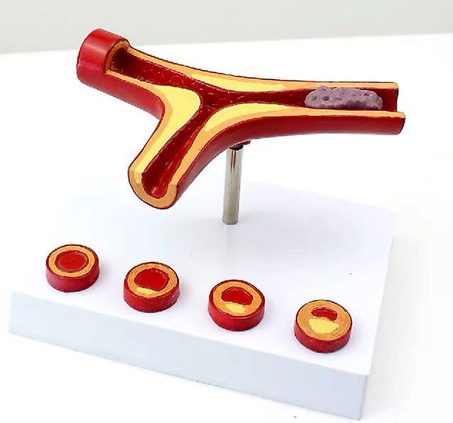 Arteriosklerose-Modell mit Thrombus für menschliche Arterie Anatomisches Modell Blutgefäßanatomie Medizinisches Geschenk Lehrmittel