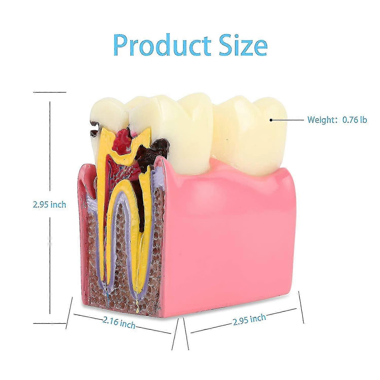 SNAWOP Dental Pathology Model Pediatric Teeth Model