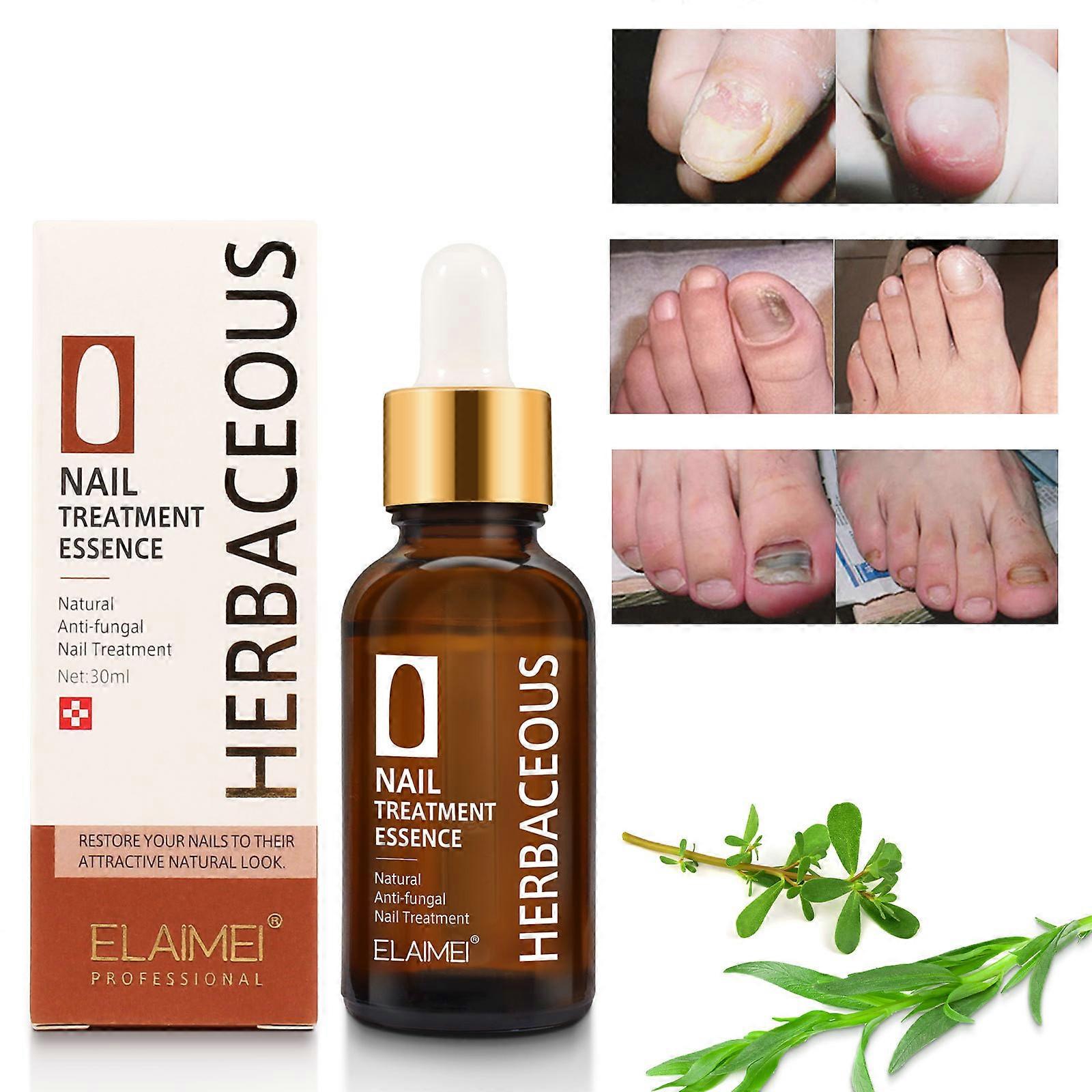 Toenailplus 抗甲沟炎缓解油 向内生长的脚趾甲滴剂 纠正脚趾甲软化剂 指甲助手 向内生长 脚趾甲修复和改善脚趾甲健康