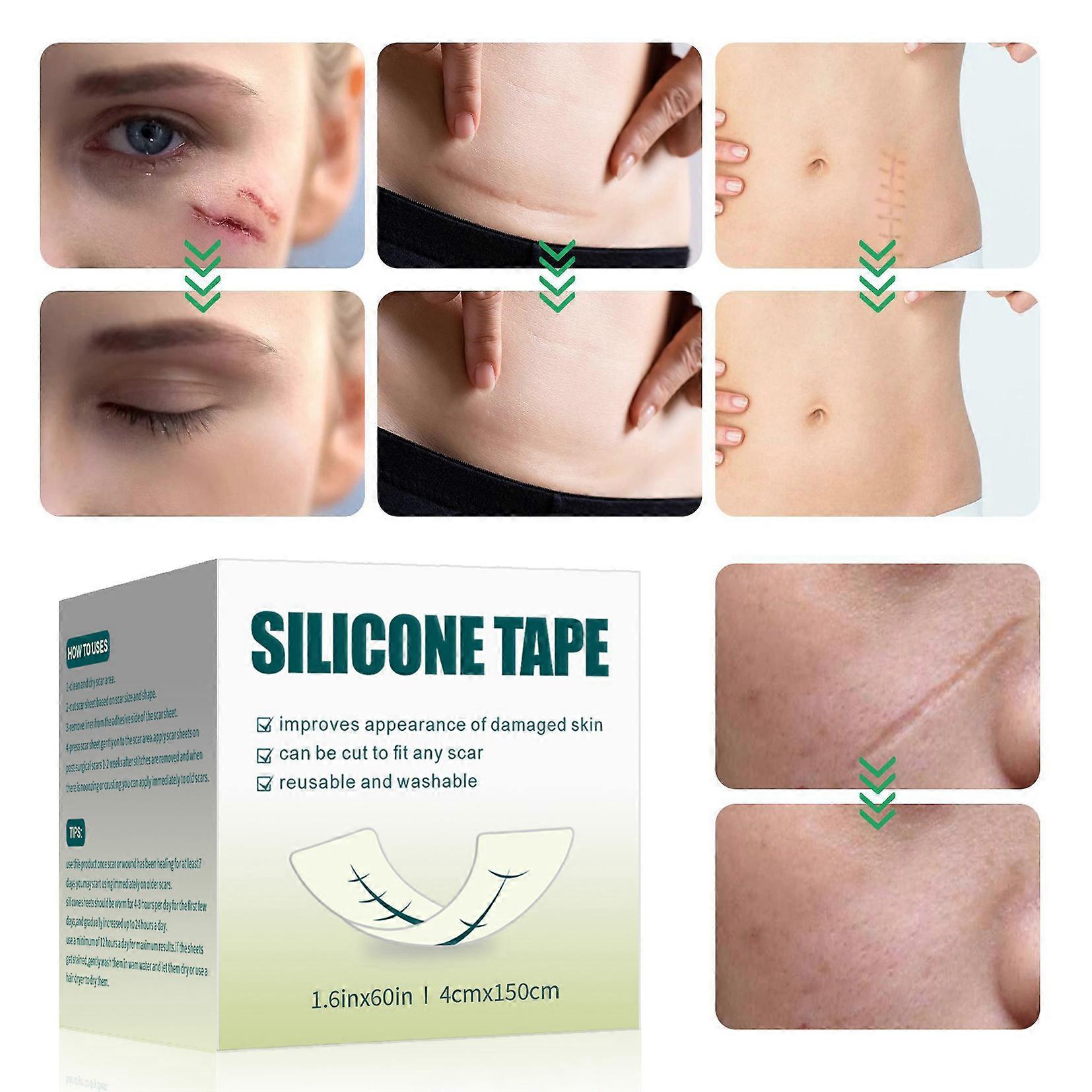 Reusable Scar Silicone Strips Keloid Surgery for C-Section Silicone Scar Tape Roll Acne 4*150cm Silicone Scar Sheets Burn