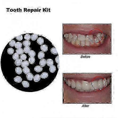 2025 Denture Solid Glue Resin Denture Adhesive Teeth Restoration Kit