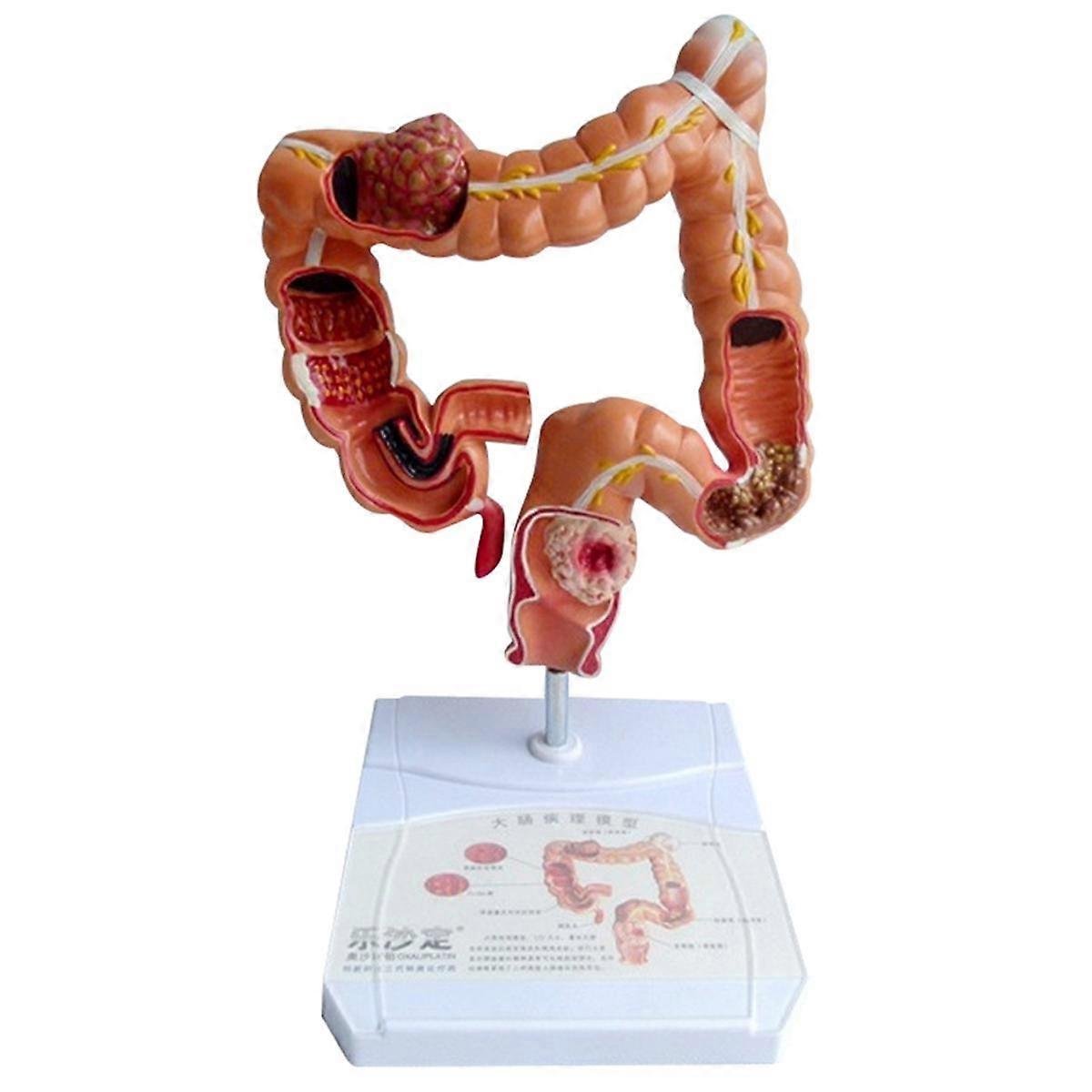 Teaching Model,Human Large Intestine Anatomy Model Visceral Lesion Model Human Digestive System Learning Model