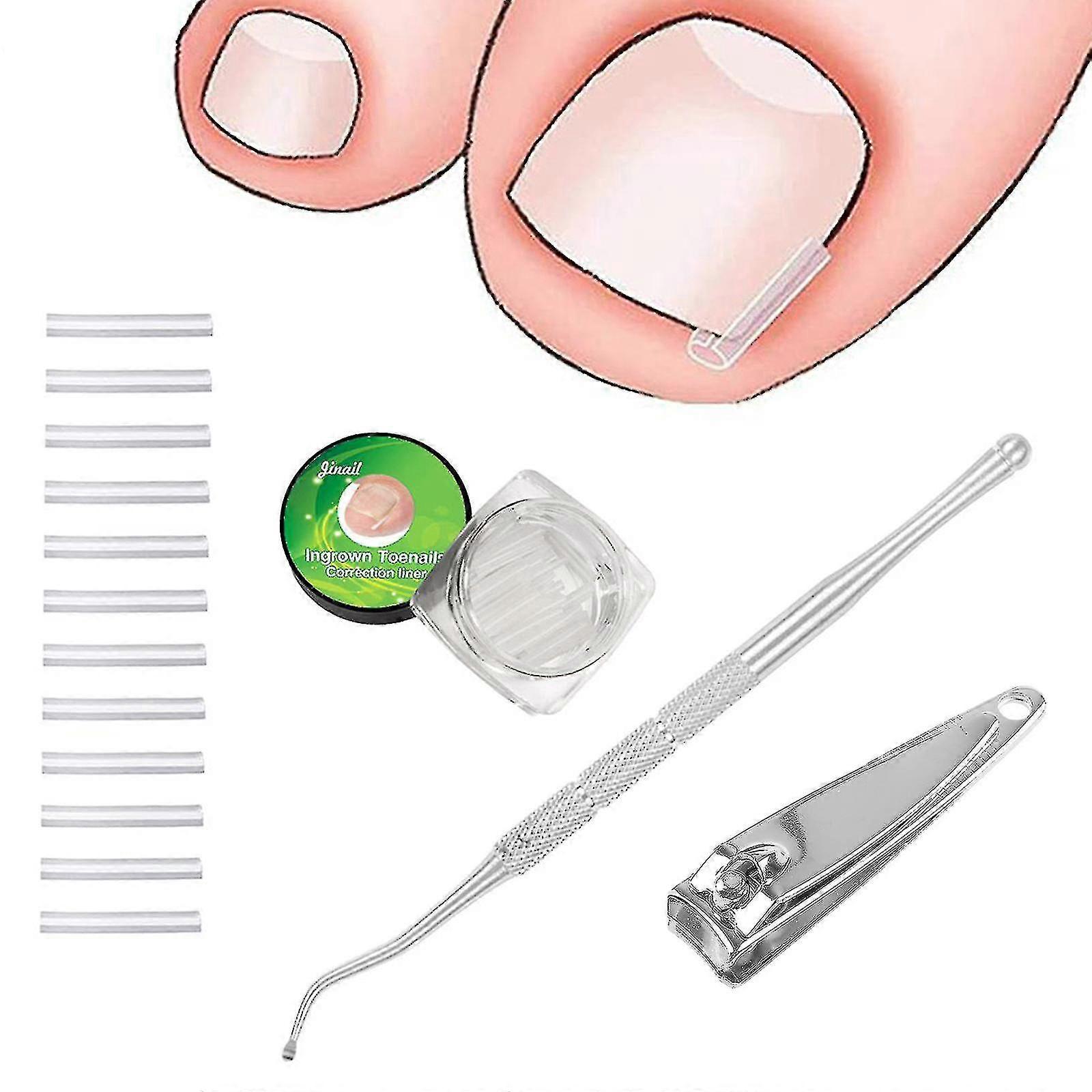 Ingrown Toenail Correction Treatment Pack Professional Ingrown Toenail Tool