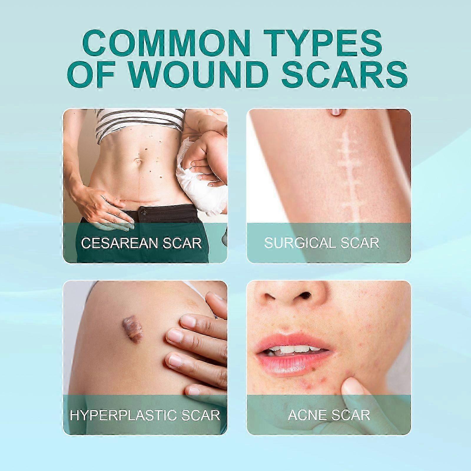 2PCS  Scar Remove Advanced Spray For All Types Of Scars, Especially Acne Scars, Surgical Scars And Stretch Marks