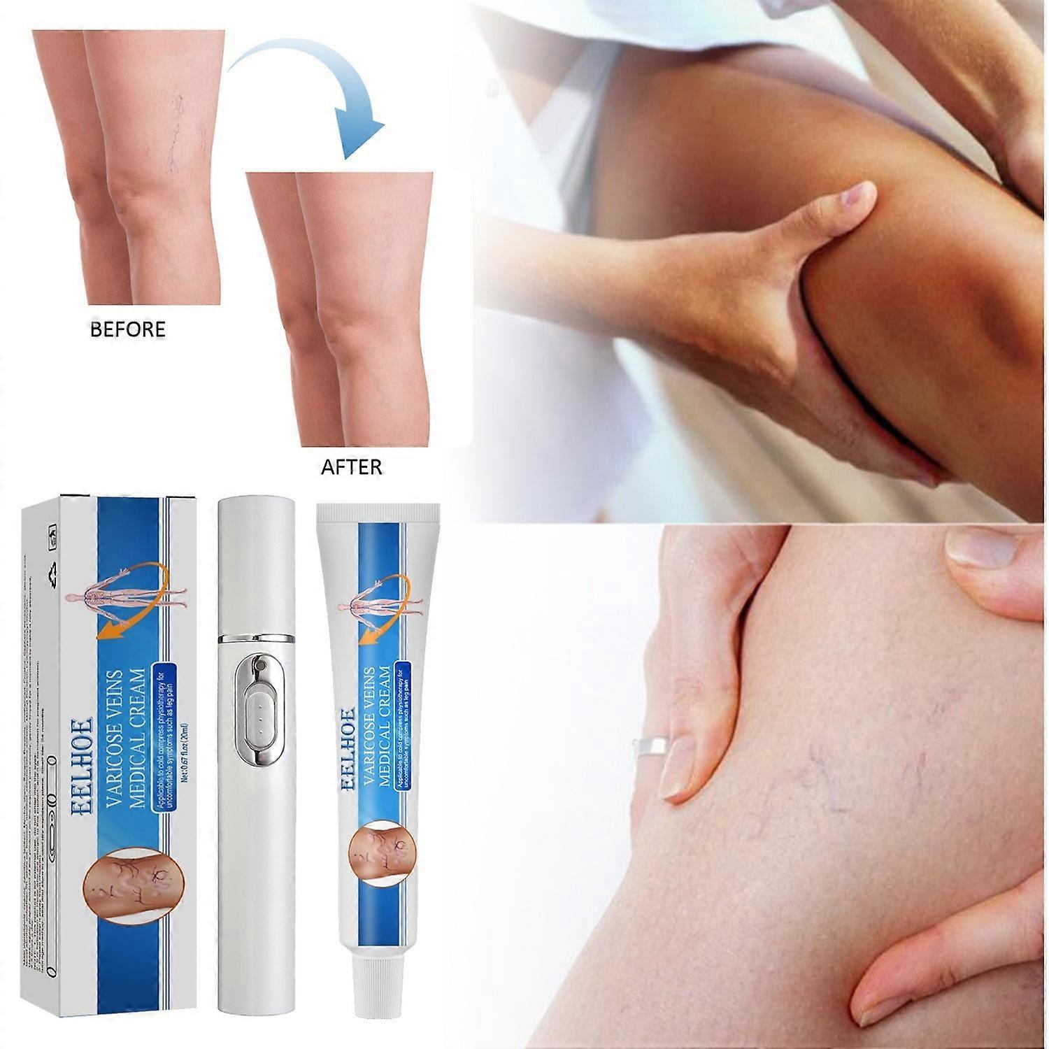 20ml Varicose Vein Soothing Massage Cream Set Portable Intravenous Spray Professional Earthworm Legs