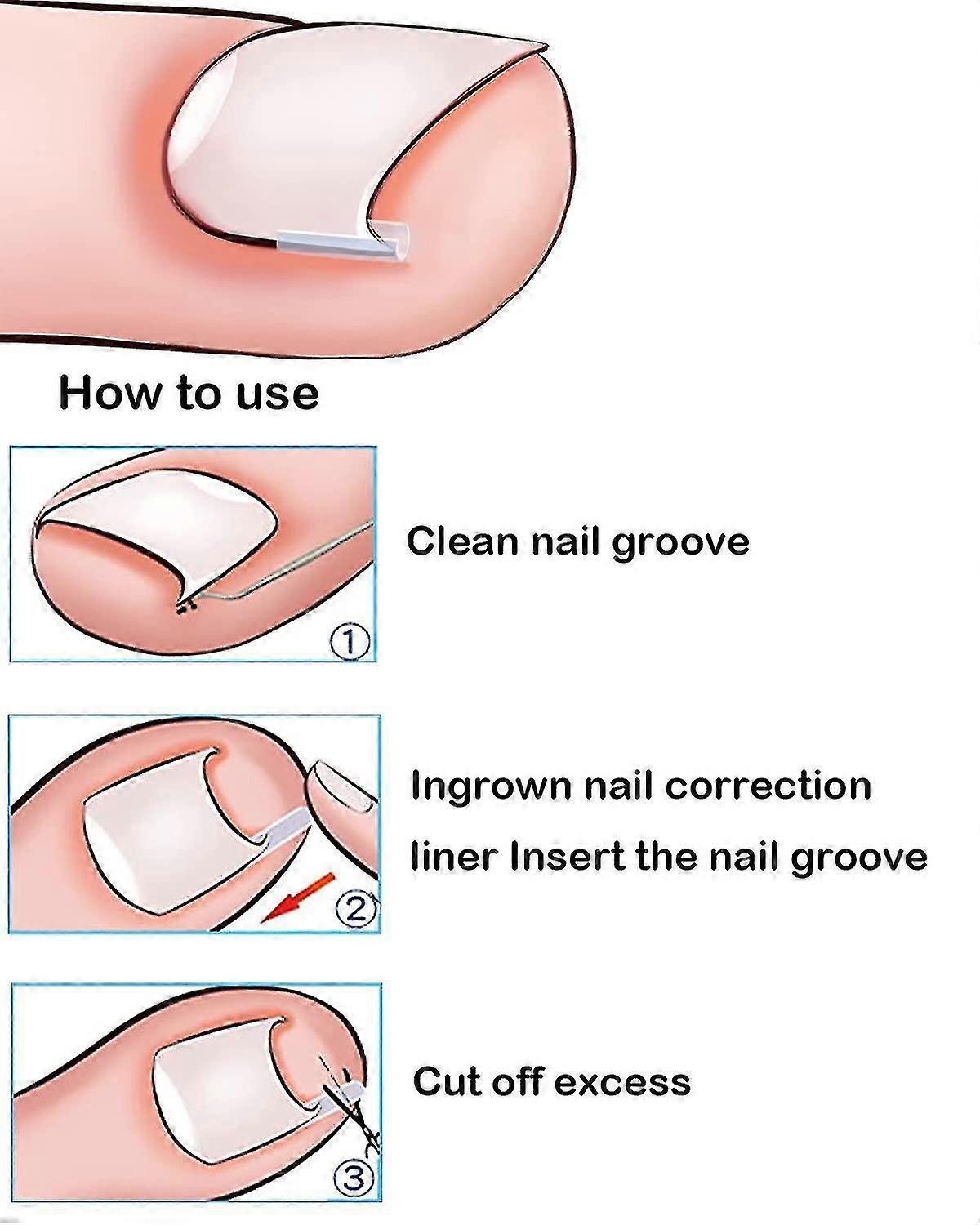 (50+2) Pack Professional Ingrown Toenail Correction Treatment Kit, 50 Pieces Ingrown Toenail Corrector Straightener With Restoration Entrainment 2 Pie
