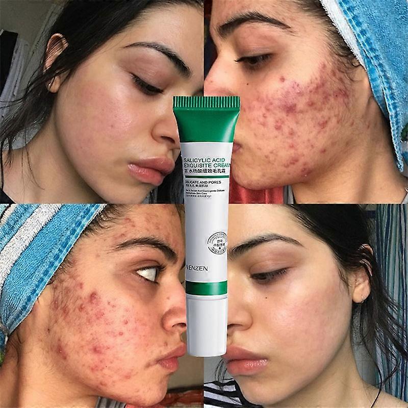 المسام يتقلص كريم ترطيب حب الشباب تحسين حب الشباب الرؤوس السوداء تبييض كريم مكافحة الشيخوخة النفط السيطرة على العناية بالبشرة