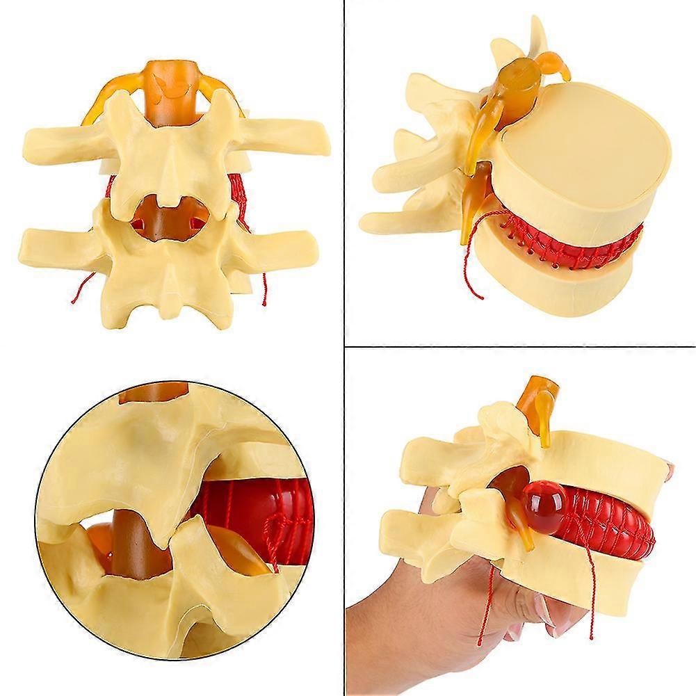 Anatomical Medical Human Spine Model for Lumbar Disc Herniation Study and Learning