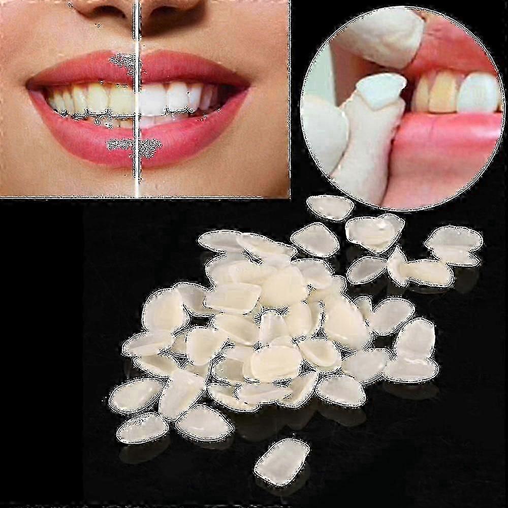 Beige Composite Resin Veneers Upper Front Teeth