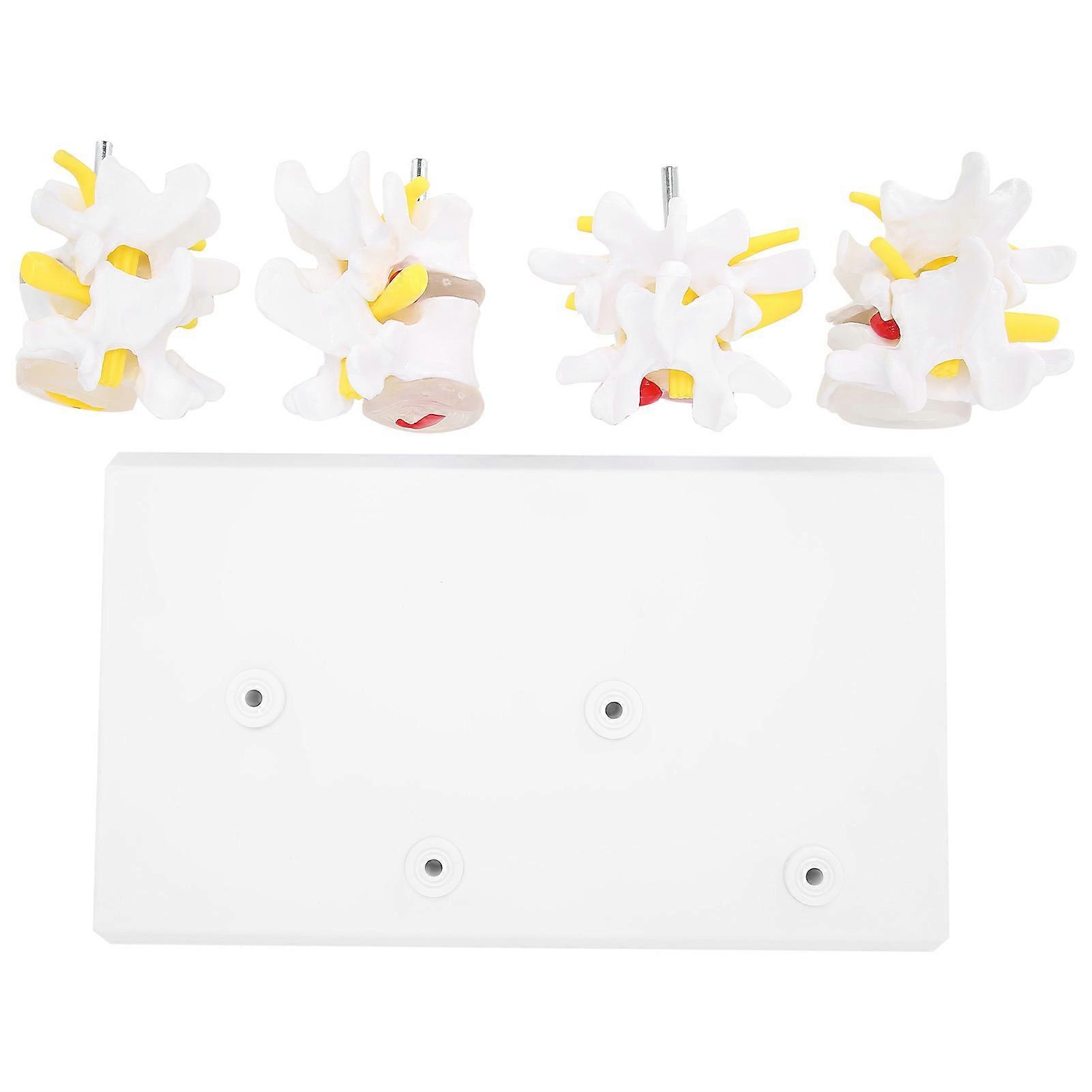 4‑Stage Human Spine Model Lumbar Vertebrae Spine Normal Pathological Models with Base