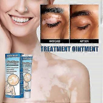 Schnell wirkende, natürliche Vitiligo-Creme zur effektiven Entfernung von Leukoplakie (weißen Flecken).