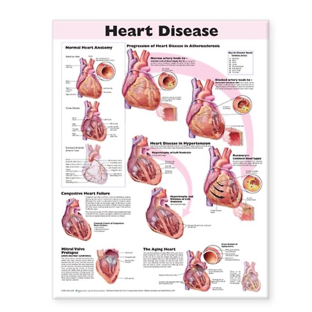 Heart Disease Anatomical Chart by Wolters Kluwer Health Wallchart Book