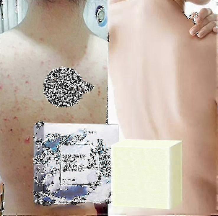 Antischimmel huidzeep Anti-mijt zeep handgemaakte zeep Zeezoutzeep Antimite olie-controle en versteviging Sk