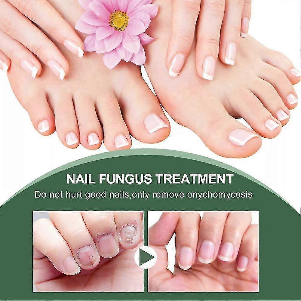Extra stark nagelsvampbehandling, bsta nagelreparation stoppa svamptillvxt Effectiv