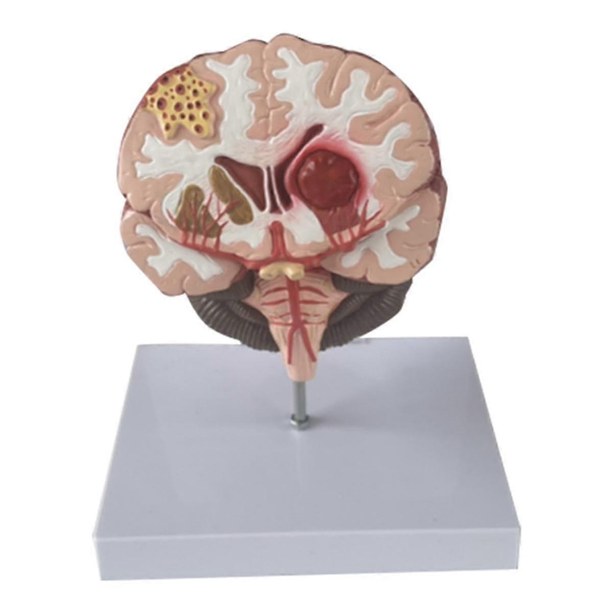 Human Brain Disease Model - Brain Pathology Brainstem Hemorrhage Medical Teaching Model - Human Brain Anatomy Model