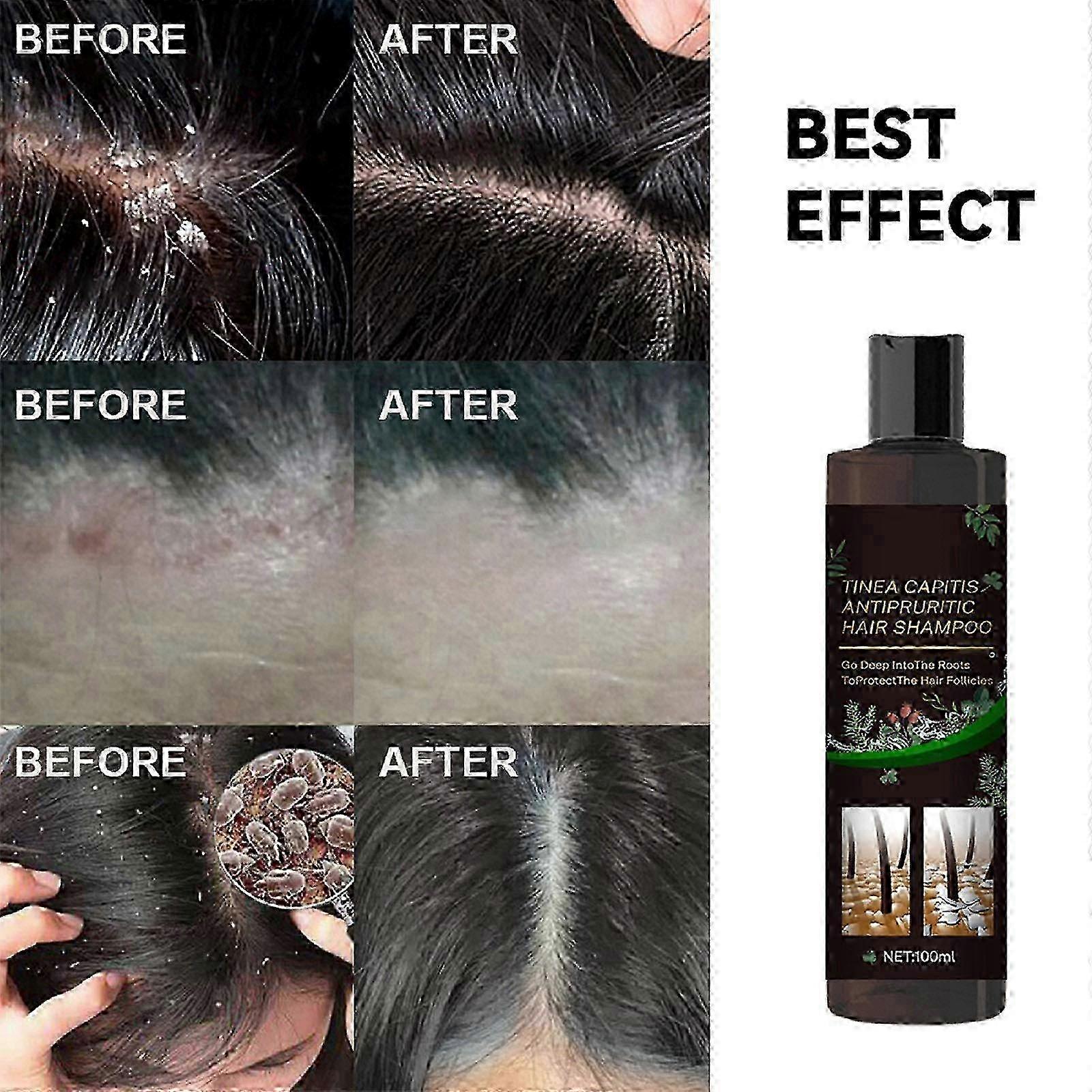 2025 Anti-itch Shampoo For Scalp Tinea Capitis To Dandruff And Relieve Itchy