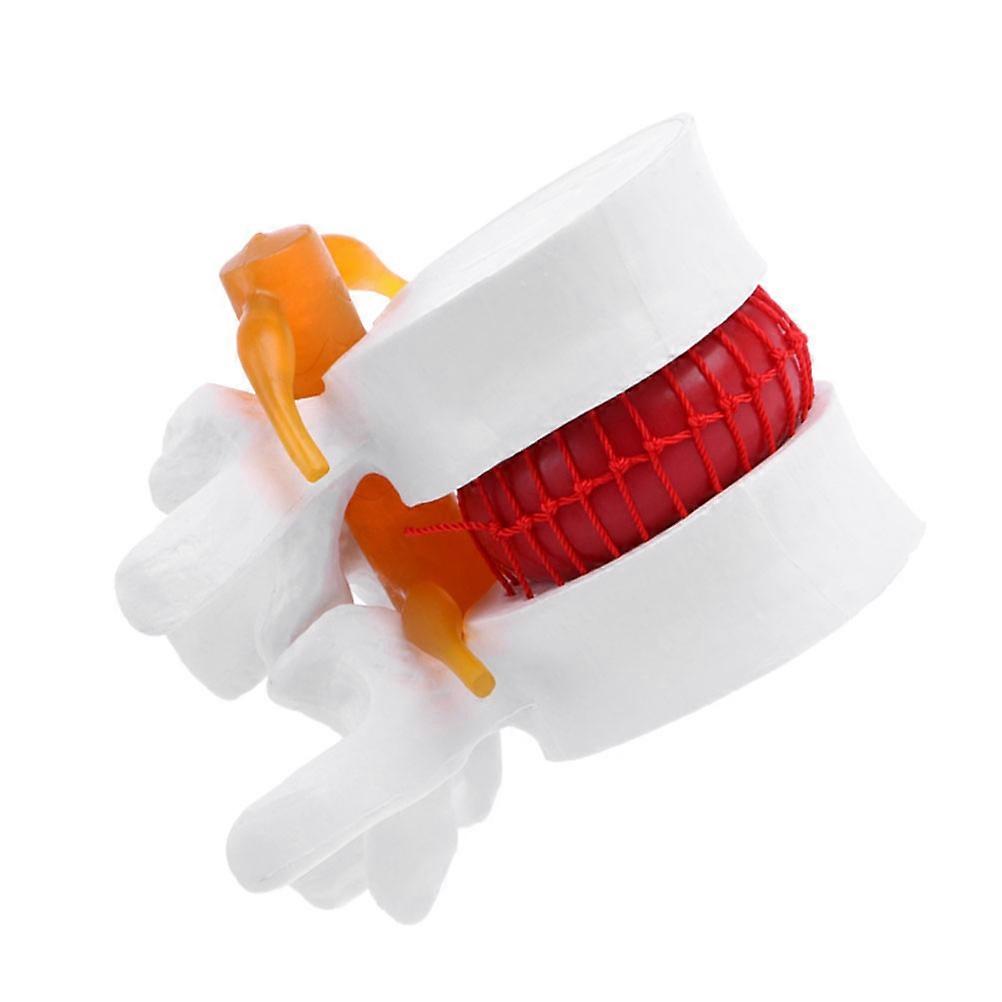 1pc Human Spine Model Lumbar Disc Herniation Presentation Model for School