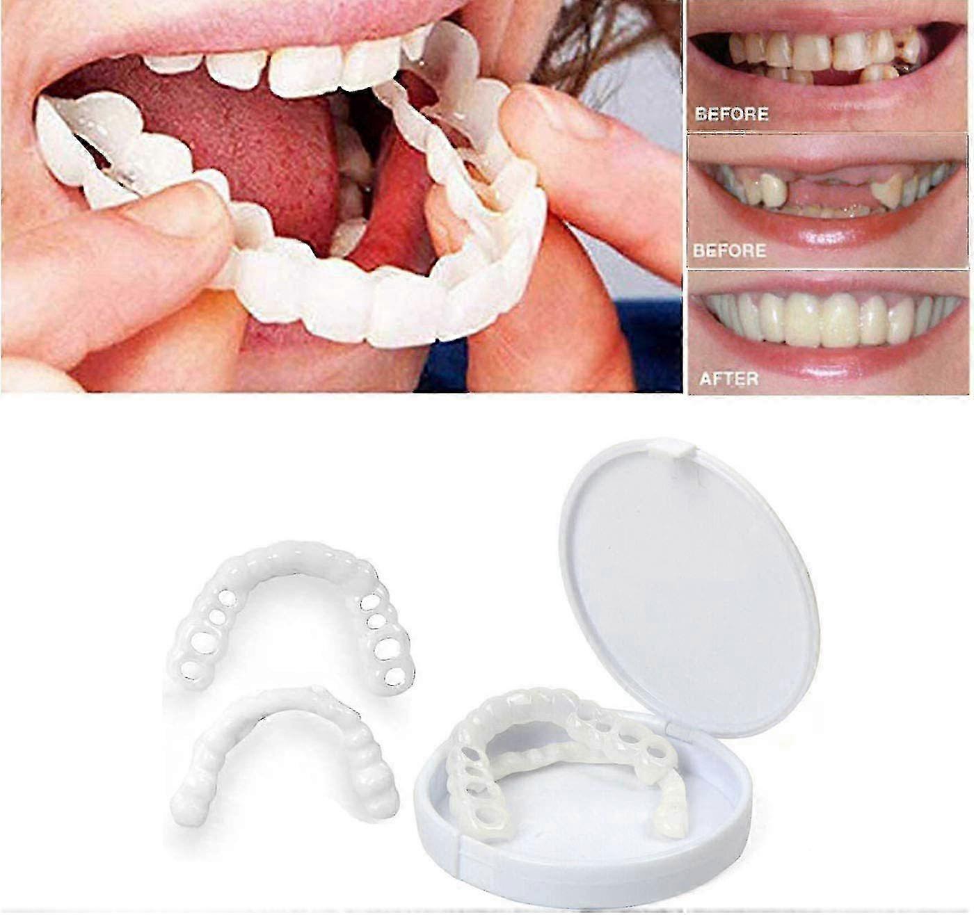 Snap-On Upper Dental Veneers Set for Fake Teeth and Denture Covers