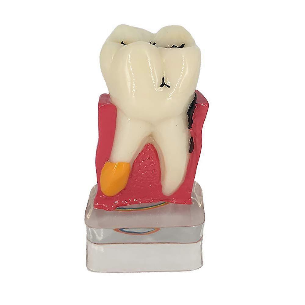 Dental Implant Model with Clear CrossSection for Teaching, Simulation and Patient Education